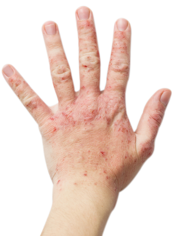 Neurodermitis