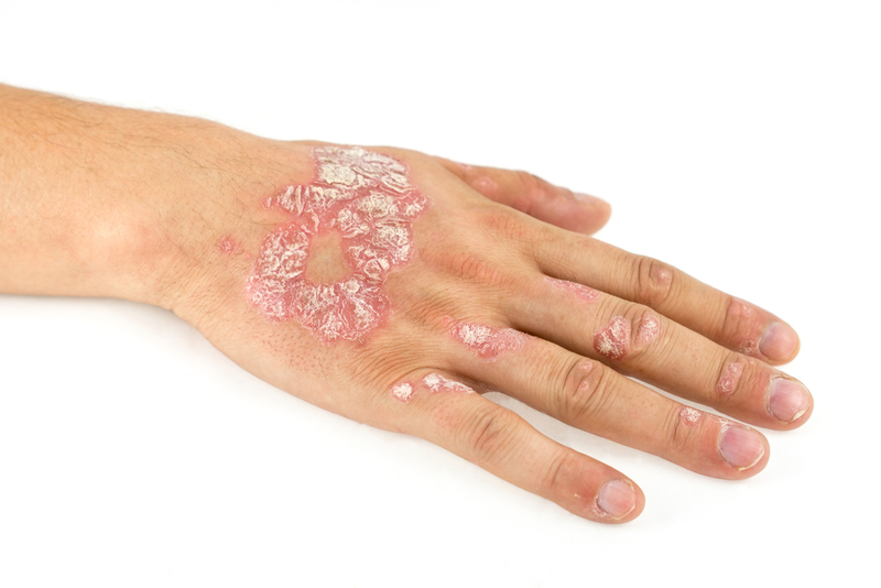 Psoriasis